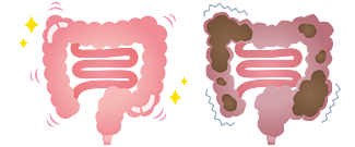 健康な大腸と便秘の大腸